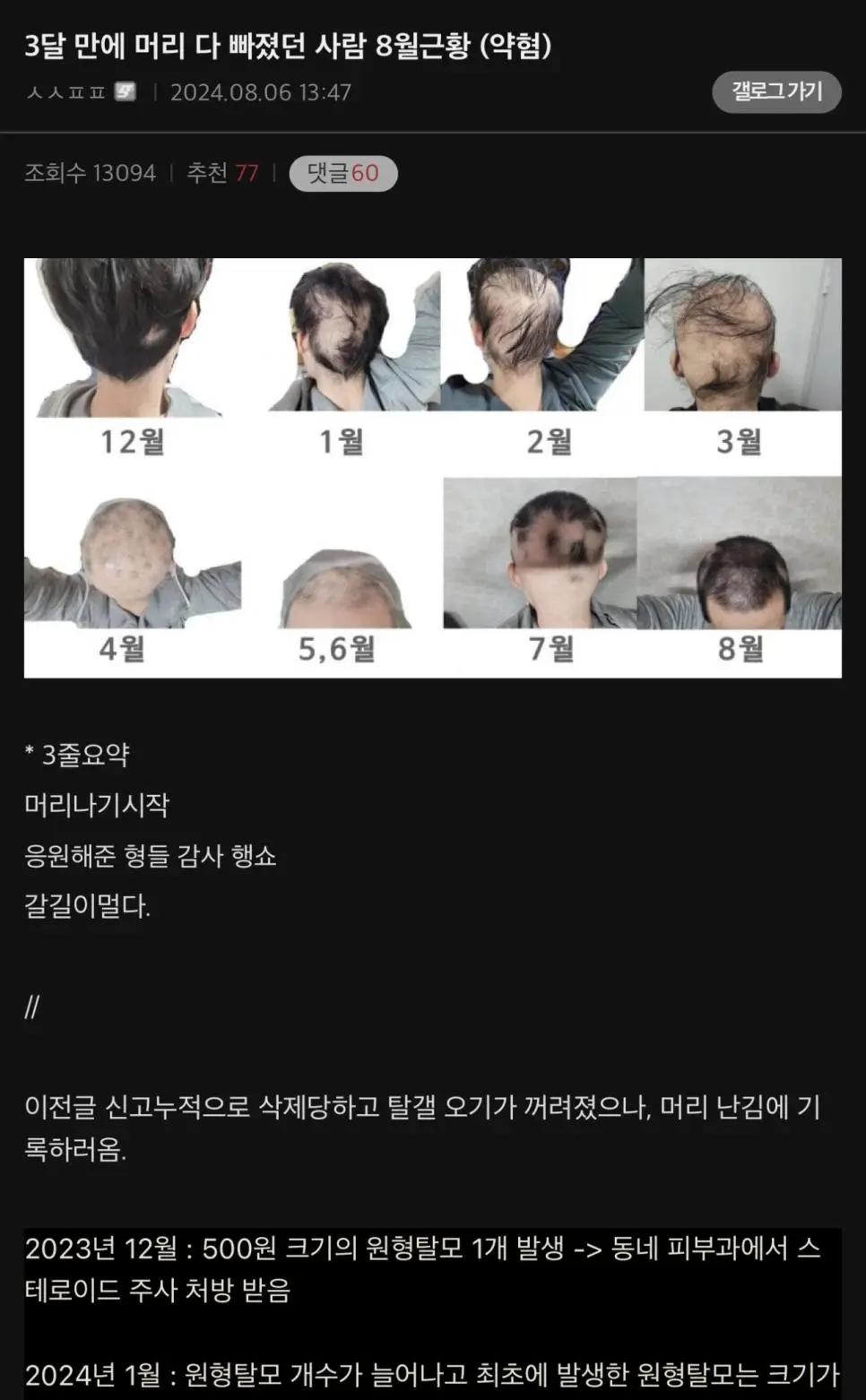 급성 탈모로 여친한테 차인 남자 근황.jpg | mbong.kr 엠봉