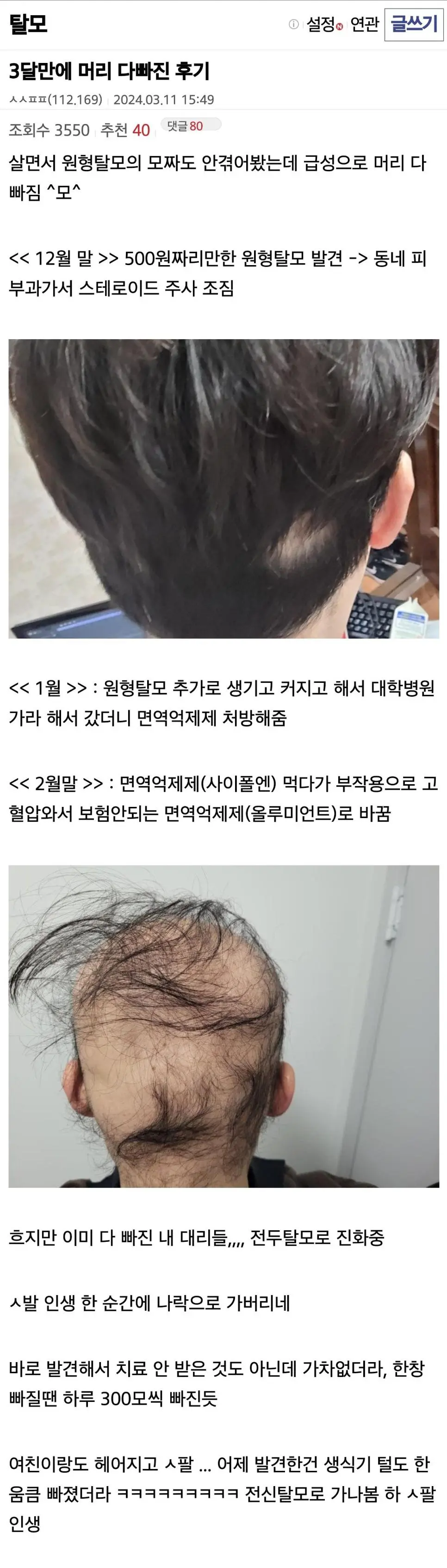 급성 탈모로 여친한테 차인 남자 근황.jpg | mbong.kr 엠봉