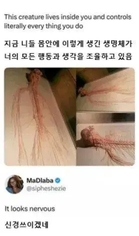 인간의 몸에서 적출된 초거대 기생생물 | mbong.kr 엠봉