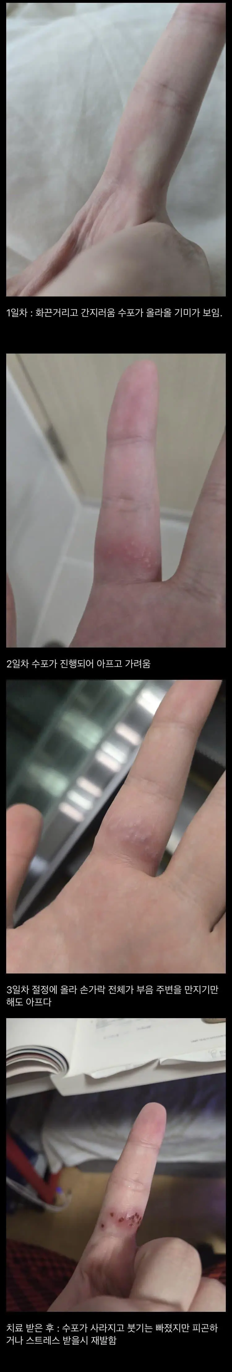 (혐)손가락 성병 걸린 후기 | mbong.kr 엠봉