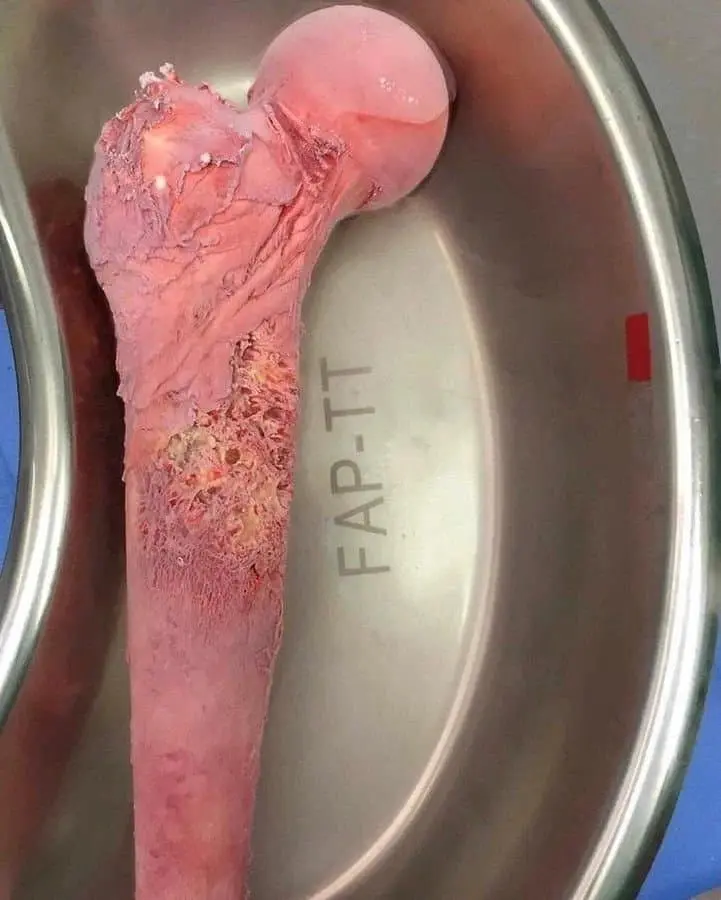 (혐) 뼈암 치료하는법 | mbong.kr 엠봉