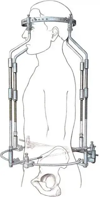 척추측만증이 심각한 어린이에게 이뤄지는 치료법 | mbong.kr 엠봉