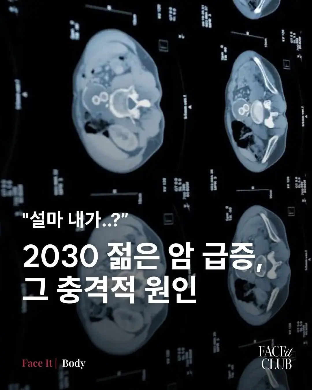 2030 젊은 암 급증, 그 충격적 원인 ㄷㄷㄷㄷㄷ | mbong.kr 엠봉