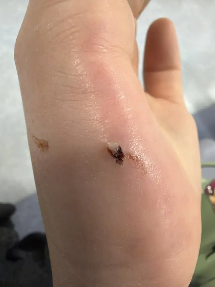 상처주의) 고양이 물림사고의 위험성. | mbong.kr 엠봉