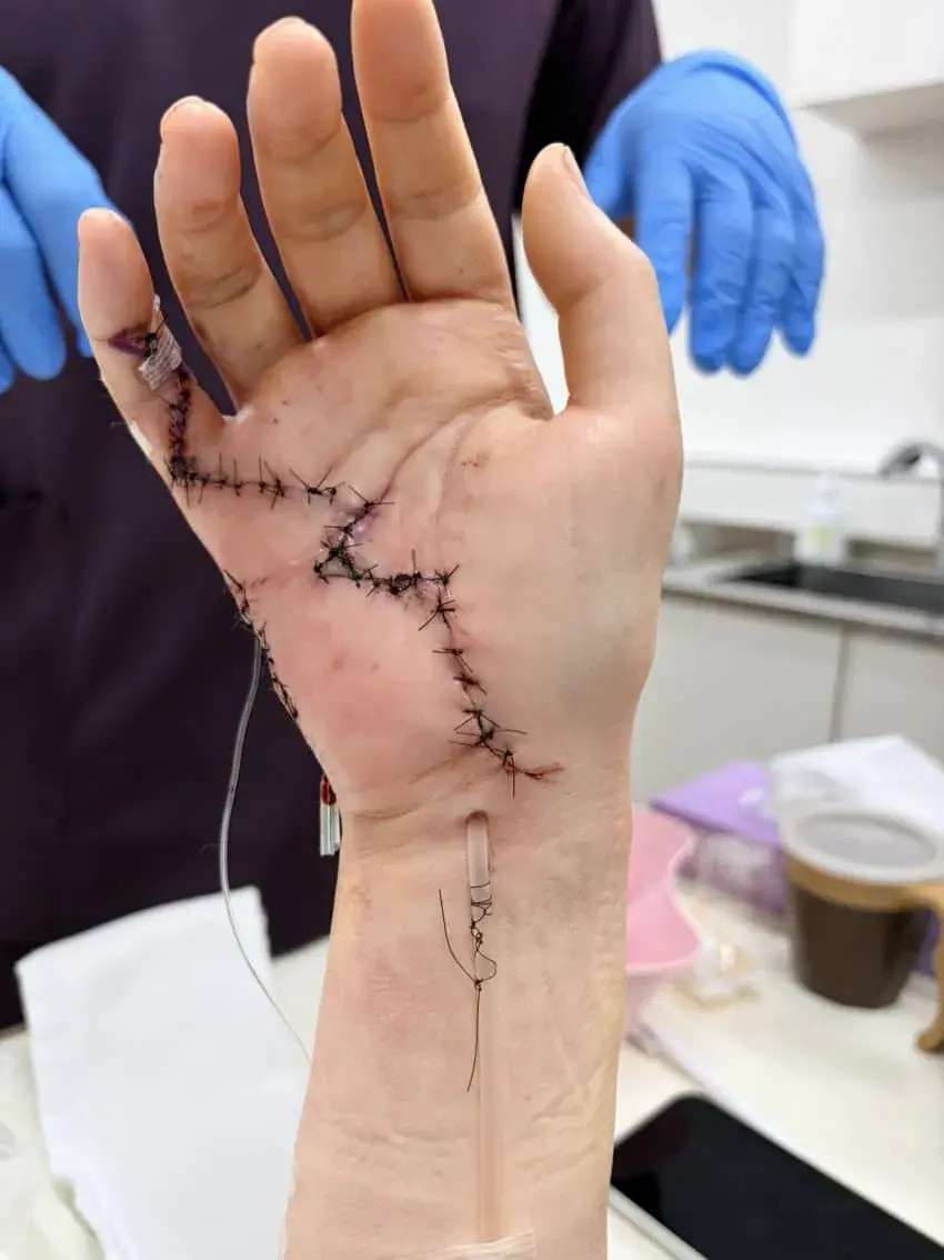 상처주의) 고양이 물림사고의 위험성. | mbong.kr 엠봉