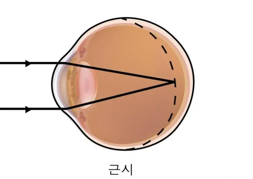 한국인 40세 이전 4명중 3명 '근시', 