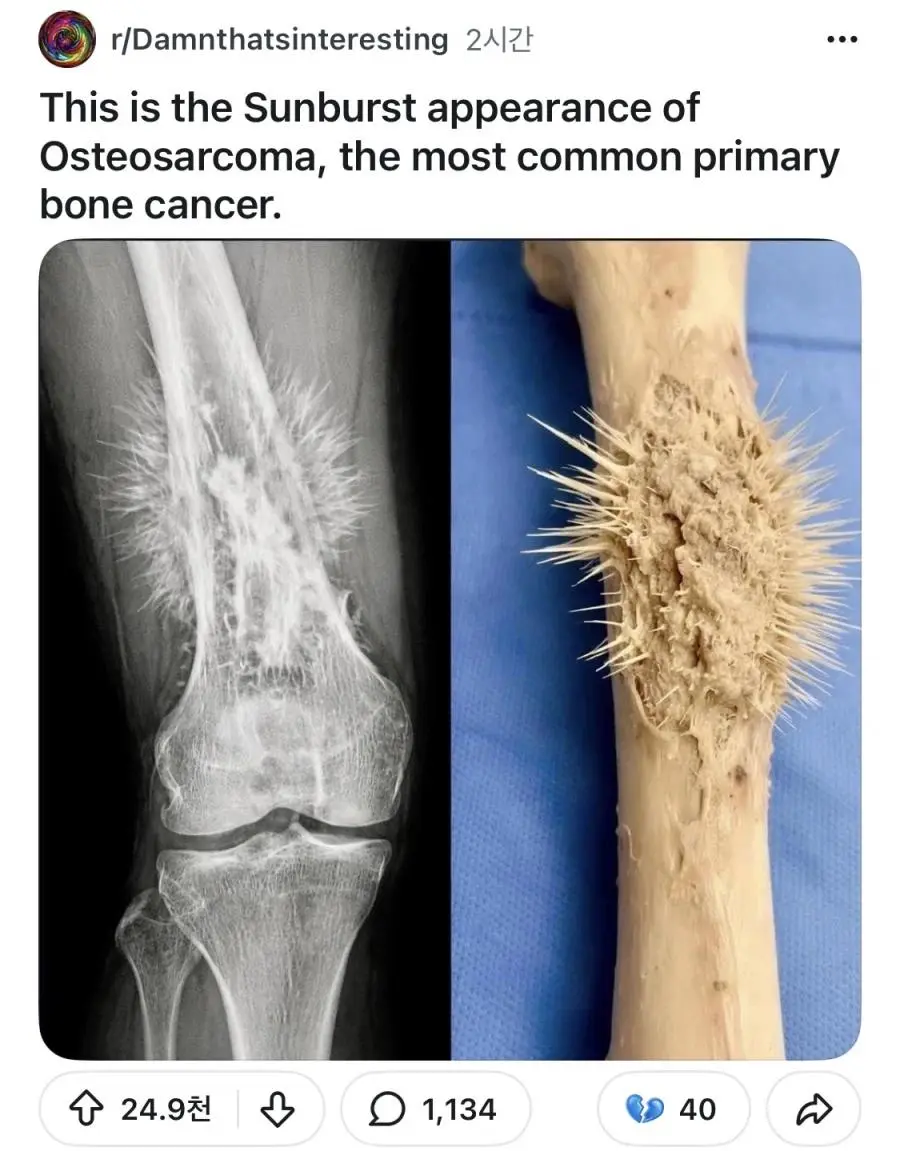 뼈에 종양이 자란 모습.jpg | mbong.kr 엠봉
